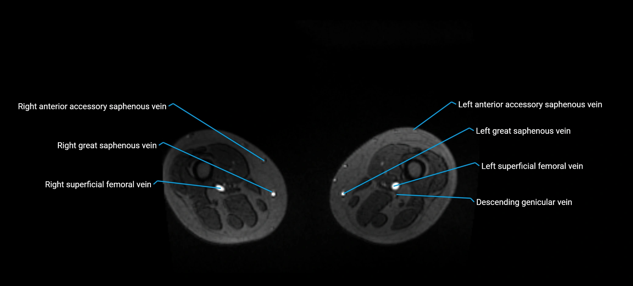 MRV abdomen pelvis & lower limb axial cross sectional anatomy labelled MRI image 314.webp